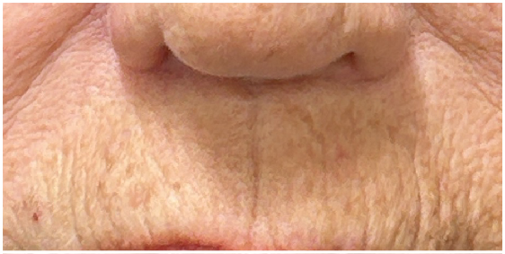 Lip Filler before — Thin Lips, Perioral Aging, Lip Lines, Fine Lines, Wrinkles, front view
