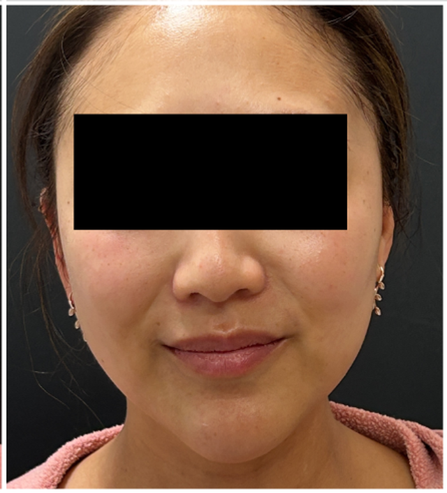 Cool Peel CO2 Before & After | Skin Texture, Tone and Enlarged Pores — after
