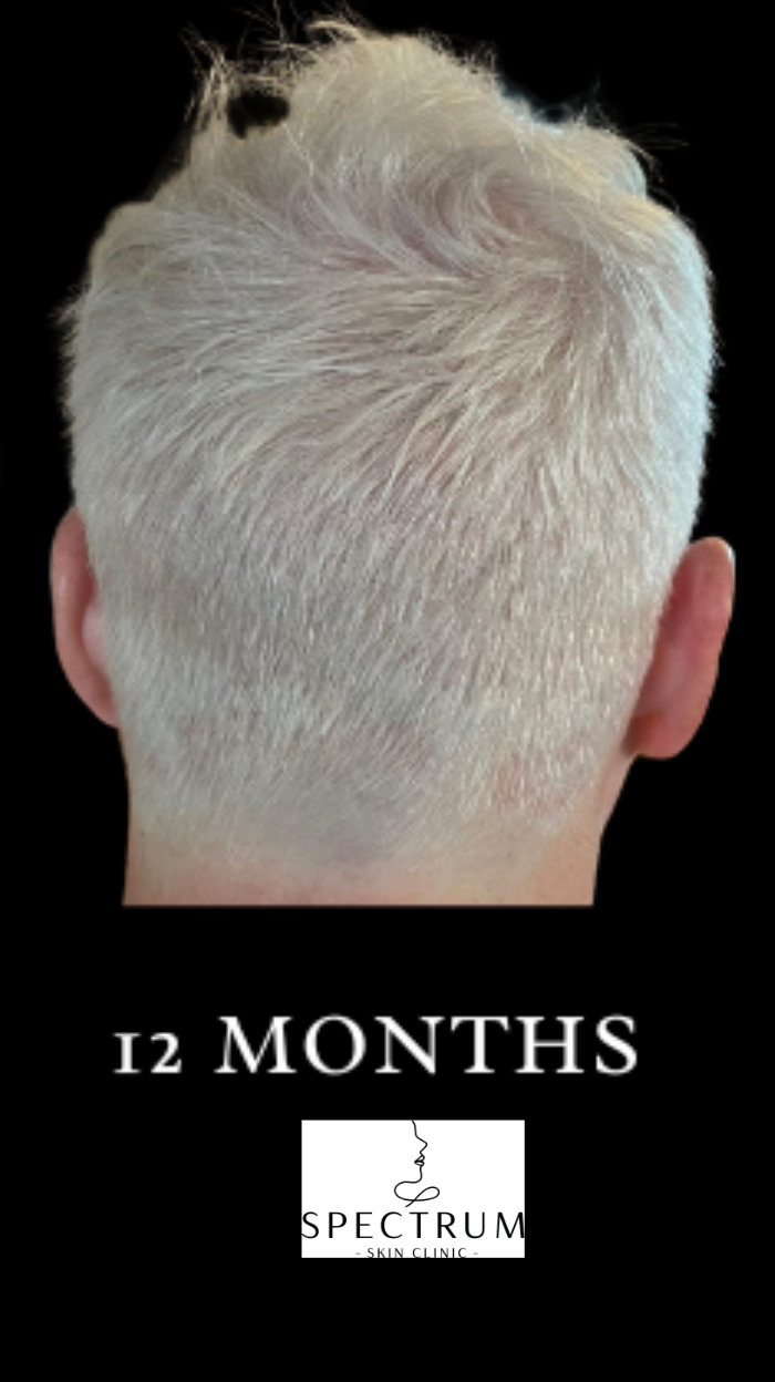 PRFM Hair Therapy after — Thinning Crown, Hair Density Loss, front view