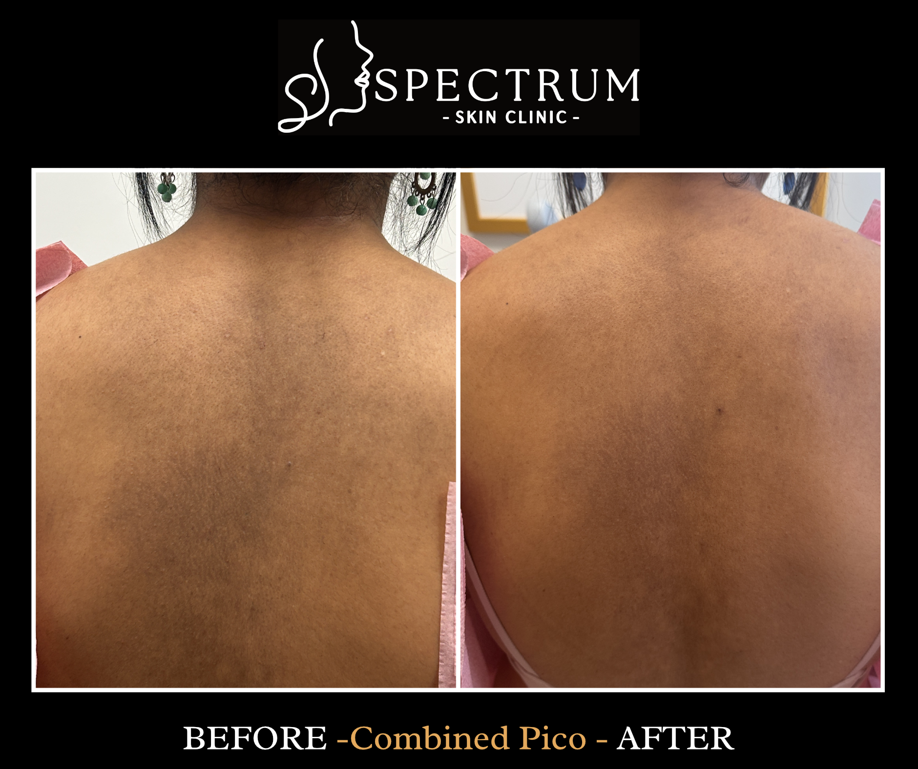 Back Hyperpigmentation Treatment Before & After | Pico Laser for Body Pigmentation