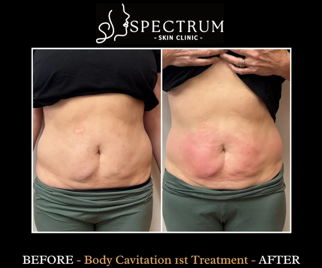 Body Cavitation Before & After | Abdominal Contouring