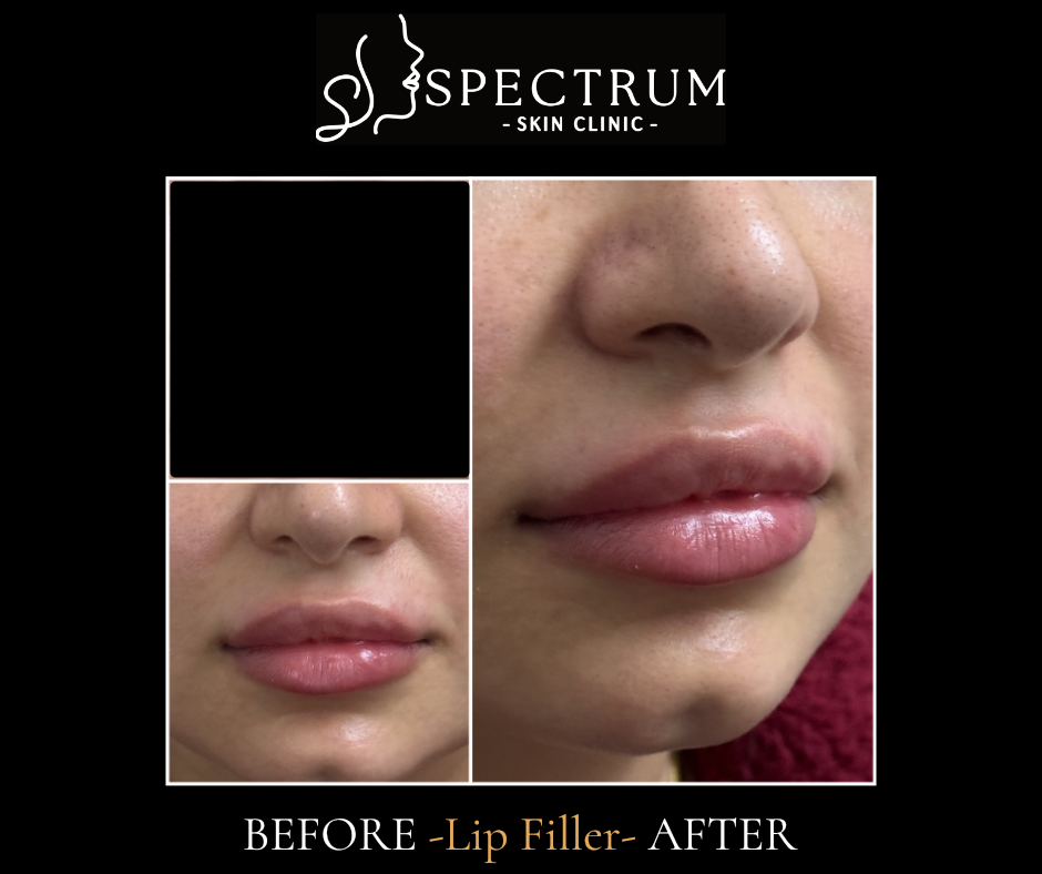 Lip Filler after — Thin Lips, front view