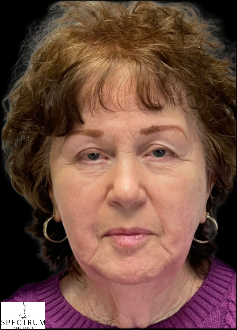 HIFU before — Sagging and Laxity, Lower Face Sagging, Skin Tightening, Volume Loss, front view