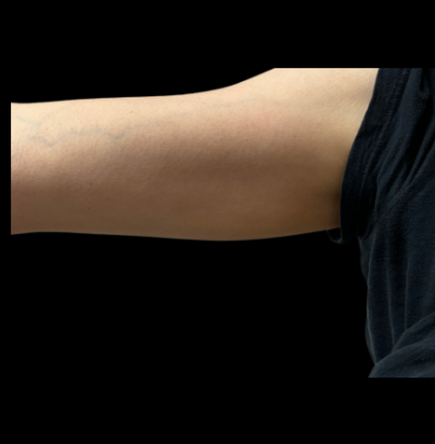 HIFU after — Upper Arm Laxity, Loose Skin, Crepey Skin, Skin Tightening, front view