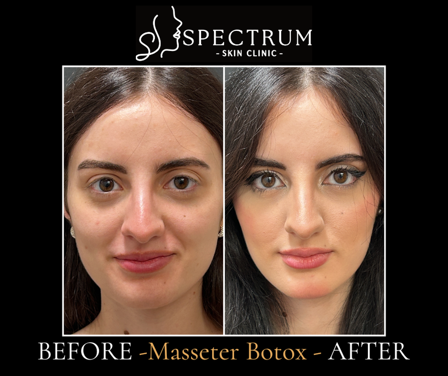 Masseter Botox Before & After | TMJ Relief and Jaw Slimming