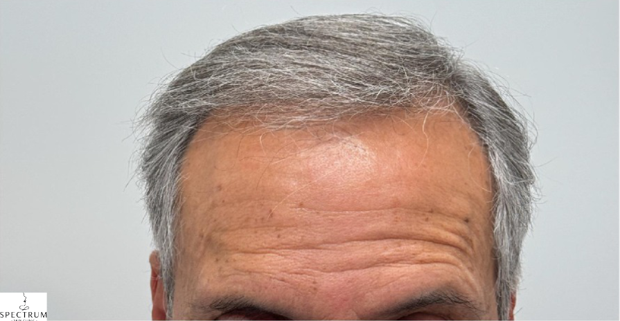 Exosome Therapy after — Male Frontal Hair Thinning, Hairline Density Loss, Mature Hair Loss, front view
