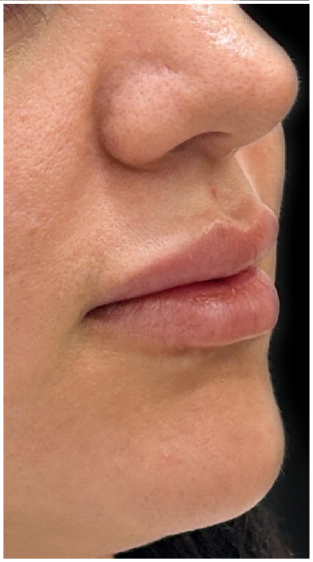 Lip Filler before — Thin Lips, front view