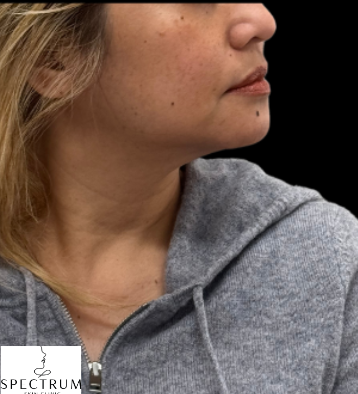 HIFU after — Sagging and Laxity, Double Chin, Lower Face Sagging, Jowling, front view