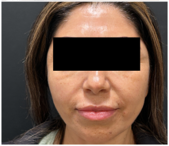 Sculptra after — Midface Volume Loss, Sagging and Laxity, Marionette Lines, Lower Face Descent, front view