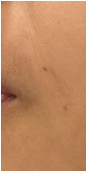 Laser Vein Removal before — Facial Veins, Spider Veins, Persistent Redness, Vascular Lesions, front view