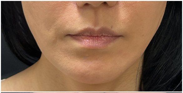 Lip Filler before — Thin Upper Lip, Lip Volume, Lip Definition, front view