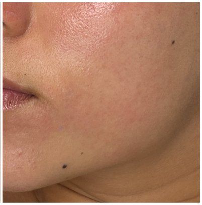Micropeel, Chemical Peel after — Sensitive Skin, Redness, Uneven Skin Tone, Dull Skin, front view