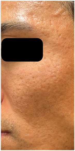 Fractional CO2, RF Microneedling, Subcision, Rejuran after — Atrophic Acne Scarring, Rolling and Boxcar Scars, Skin Texture, front view