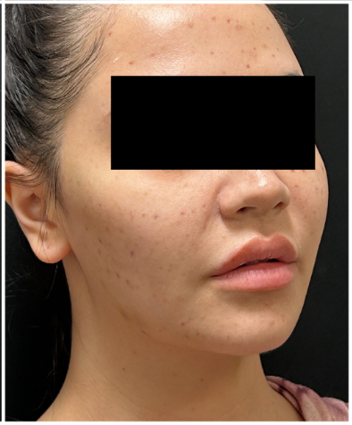 HIFU after — Sagging and Laxity, Lower Face Contour, Jawline Definition, Skin Tightening, front view