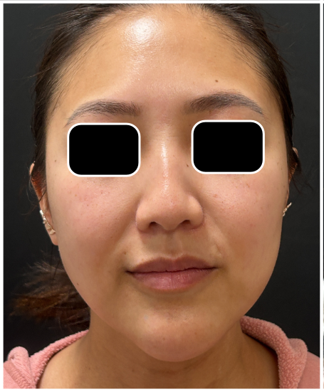 Cool Peel CO2 before — Dullness, Uneven Texture, Fine Lines, Sun Damage, Uneven Tone, front view