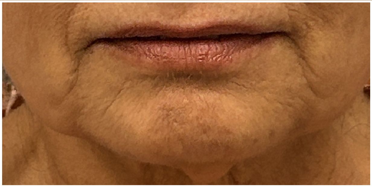 Marionette Filler, Facial Balancing before — Marionette Lines, Lower Face Sagging, Lower Face Definition, front view