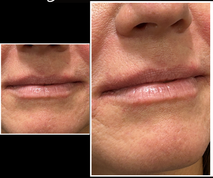 Lip Filler after — Perioral Aging, Lip Lines, front view