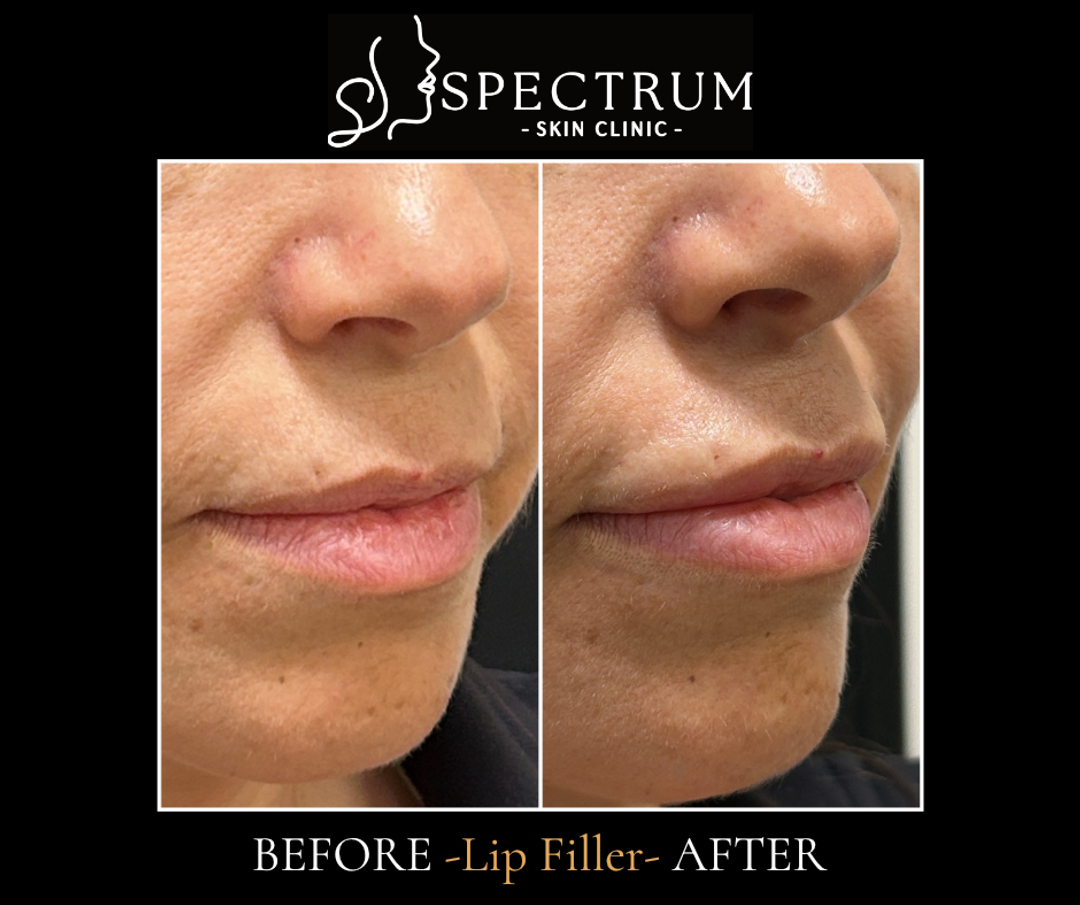 Lip Filler Before and After | Oblique View Lip Projection and Profile Balance