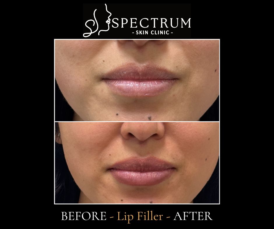 Lip Filler Before & After | Volume and Border Definition (Close View)