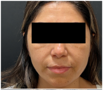 Sculptra before — Midface Volume Loss, Sagging and Laxity, Marionette Lines, Lower Face Descent, front view