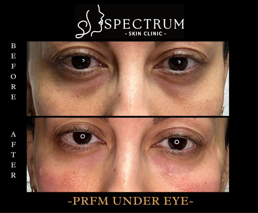 PRFM Under Eye Before & After | Dark Circles and Texture Treatment