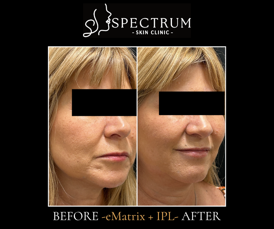 eMatrix + IPL Before and After, Skin Laxity, Tone and Texture Rejuvenation at Spectrum Skin Clinic, Irvine