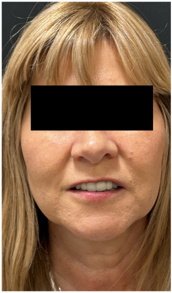 eMatrix + IPL before — Photodamage, Skin Laxity, Uneven Skin Texture, front view