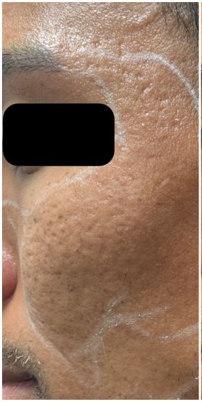 Fractional CO2, RF Microneedling, Subcision, Rejuran before — Atrophic Acne Scarring, Rolling and Boxcar Scars, Skin Texture, front view