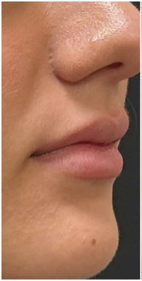 Lip Filler before — Thin Lips, front view