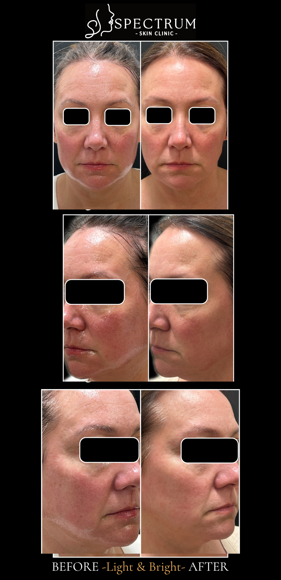 Light & Bright IPL Before & After | Tone and Clarity