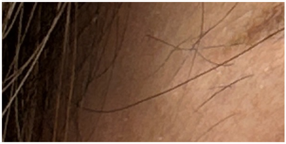 eyebrow-tattoo-removal after — unwanted-tattoo, front view