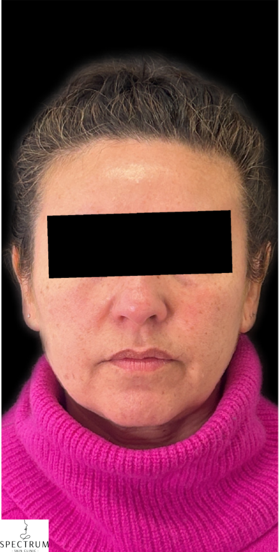 Sculptra after — Midface Volume Loss, Sagging and Laxity, Collagen Loss, Hollow Cheeks, front view