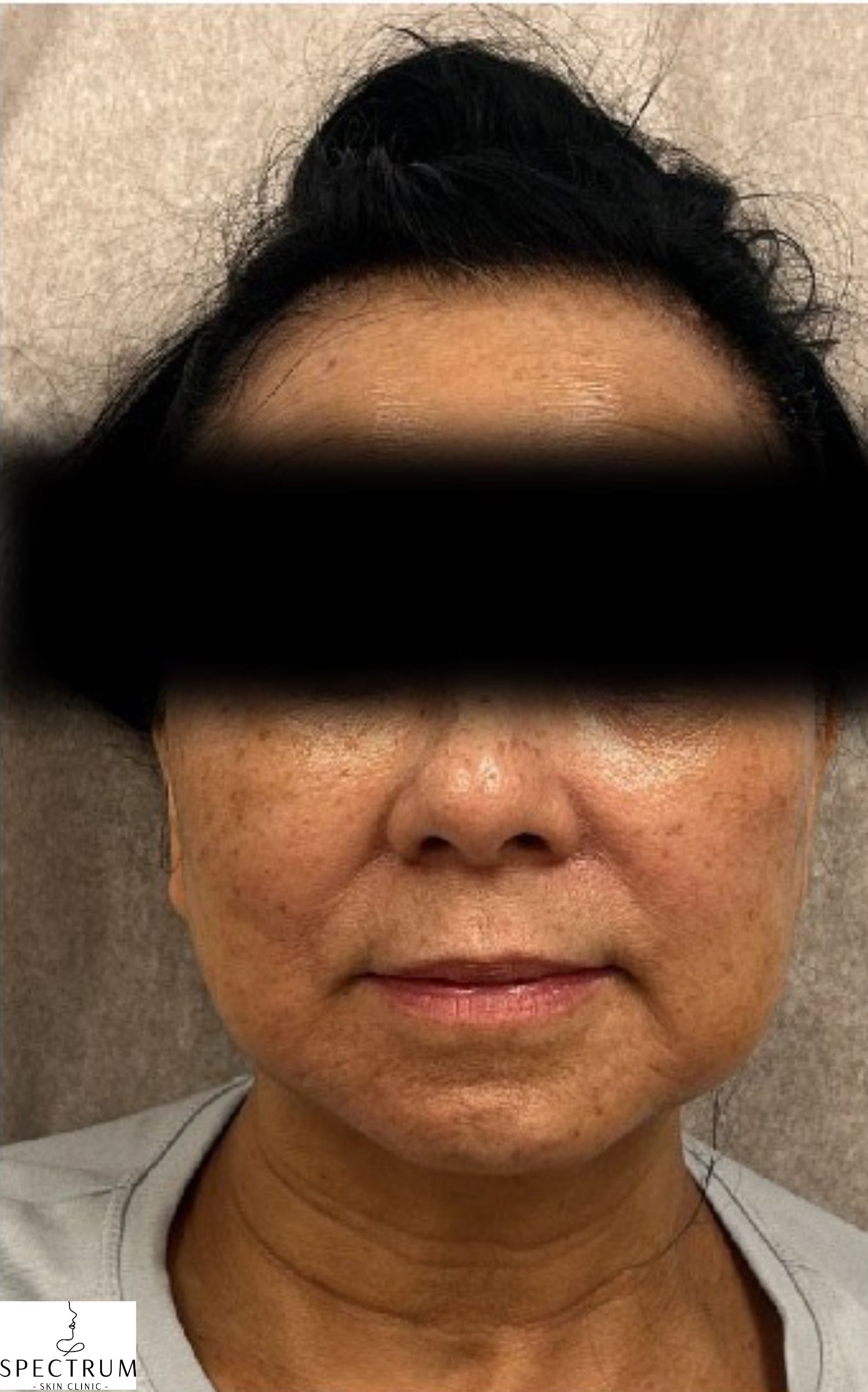 IPL Photofacial before — Sun Damage, Hyperpigmentation, Uneven Skin Tone, Facial Redness, Visible Vessels, front view