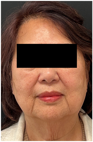 Secret PRO before — Uneven Texture, Fine Lines and Wrinkles, Enlarged Pores, Sagging and Laxity, front view