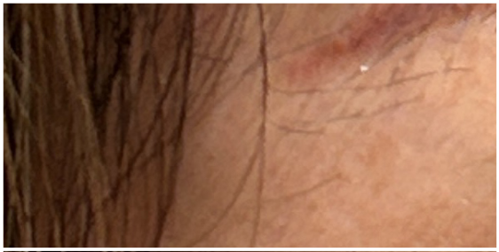 eyebrow-tattoo-removal before — unwanted-tattoo, front view