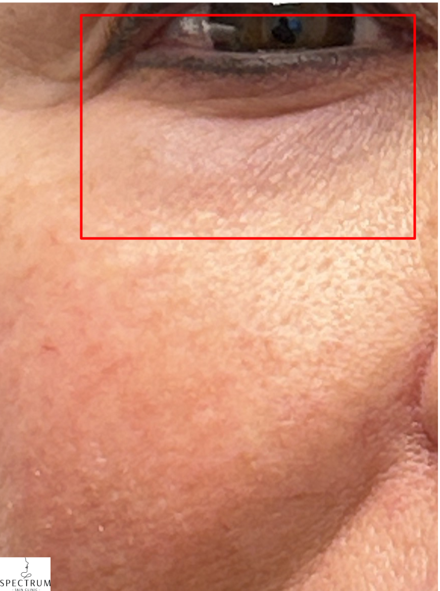 Filler Dissolve before — Under Eye Hollows, Tear Trough, Under Eye Bags and Puffiness, front view