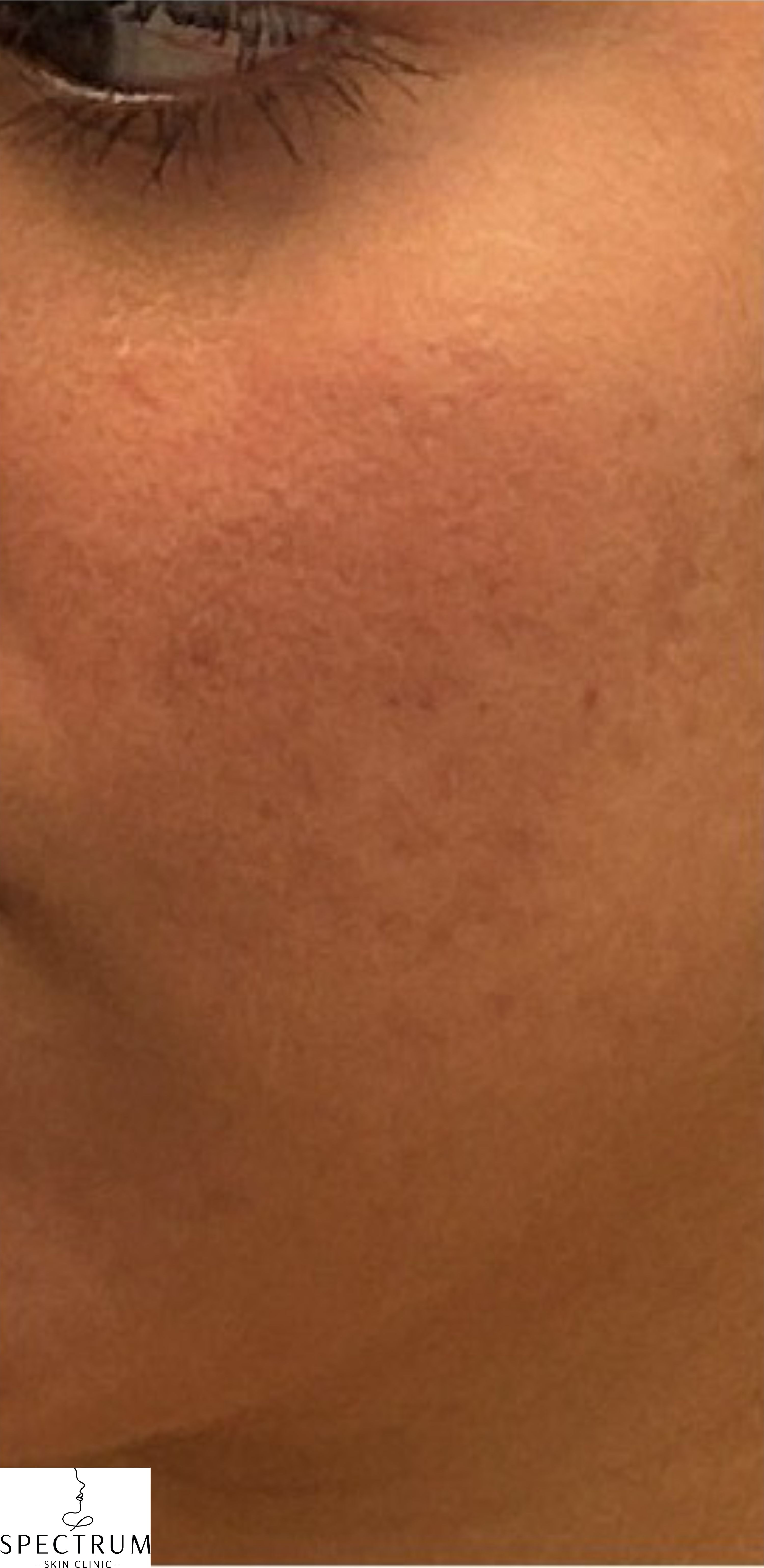 Salicylic Acid Peel before — Active Acne, Post-Inflammatory Hyperpigmentation, Uneven Texture, Inflamed Skin, front view