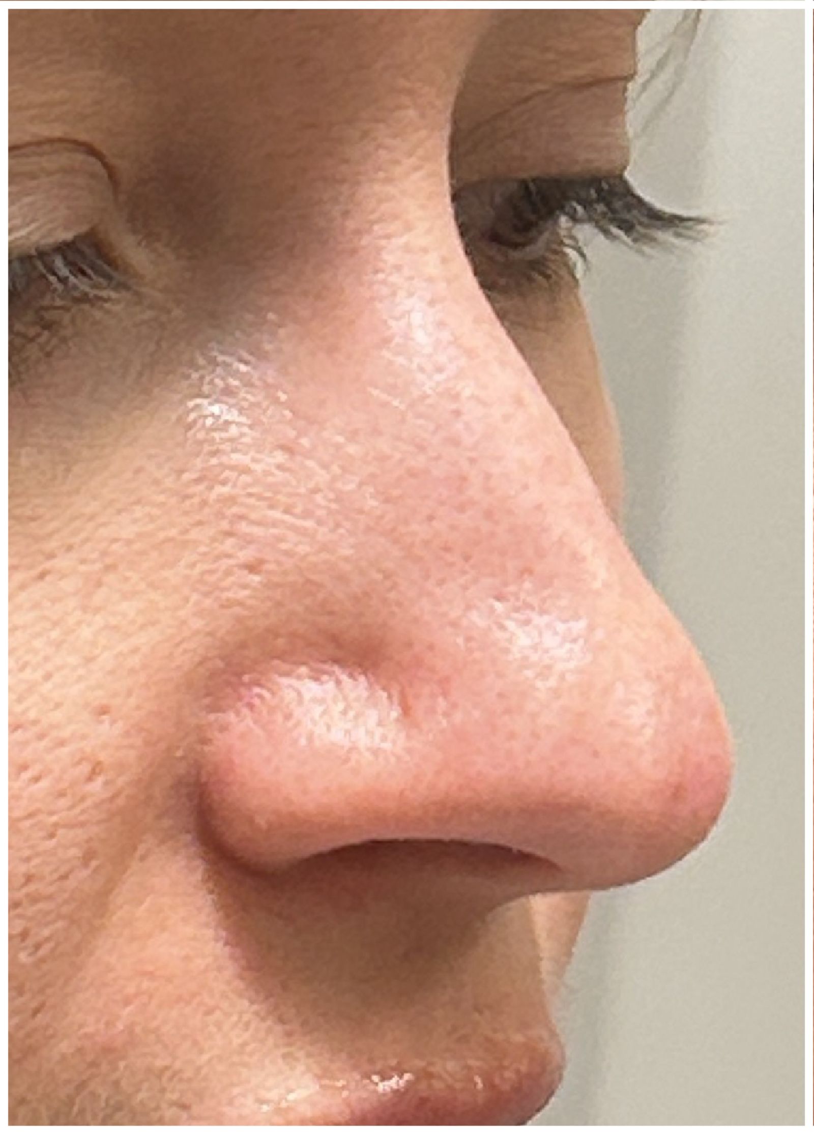 Nasal Filler Dissolve before — Filler Migration, Nasal Contour Distortion, Over-Filled Nose, front view