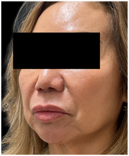 Cheek Filler, Facial Balancing, Restylane before — Midface Volume Loss, Nasolabial Folds, Lower Face Sagging, front view