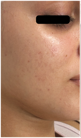 Acne Facial before — Active Acne, Inflammatory Acne, Comedones, Breakouts, front view