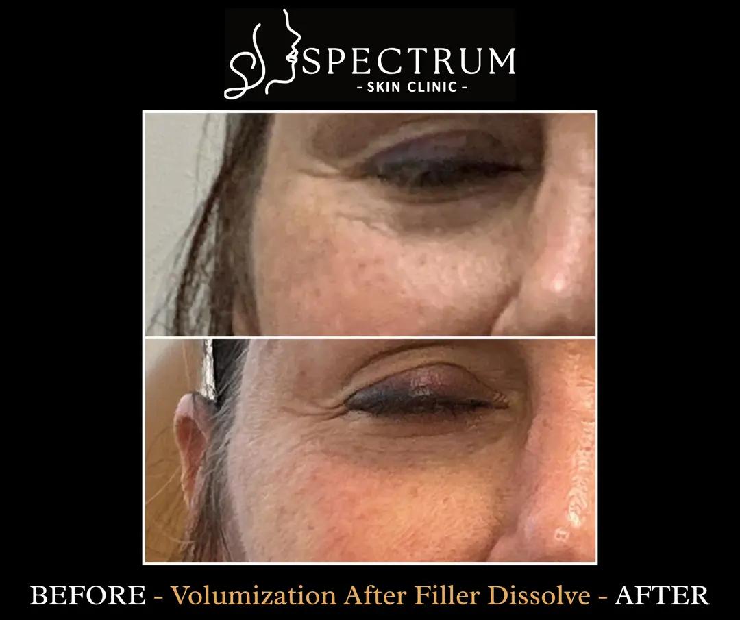 Filler Dissolve and Restoration Before and After | Midface Reset