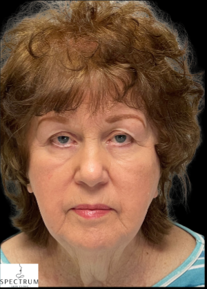 HIFU after — Sagging and Laxity, Lower Face Sagging, Skin Tightening, Volume Loss, front view