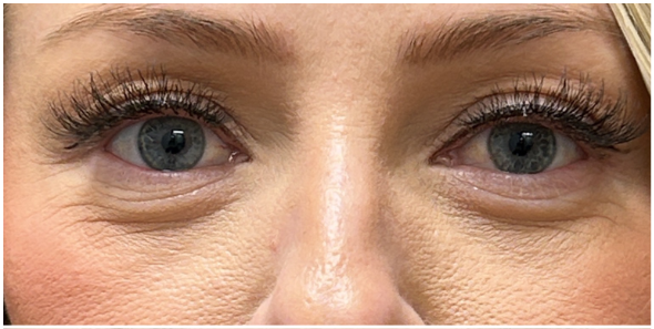 PRFM Under Eye before — Fine Lines and Wrinkles, Crepey Eyelid Skin, Skin Quality, front view