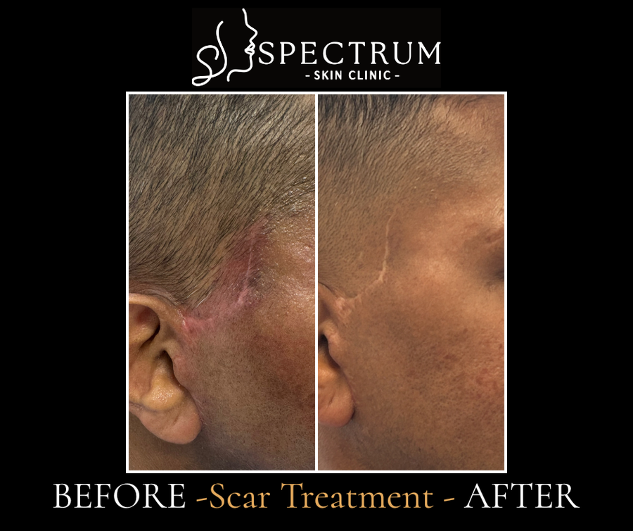 Facial Scar Treatment Before & After, Trauma Scar Recovery in a Male Patient at Spectrum Skin Clinic, Irvine