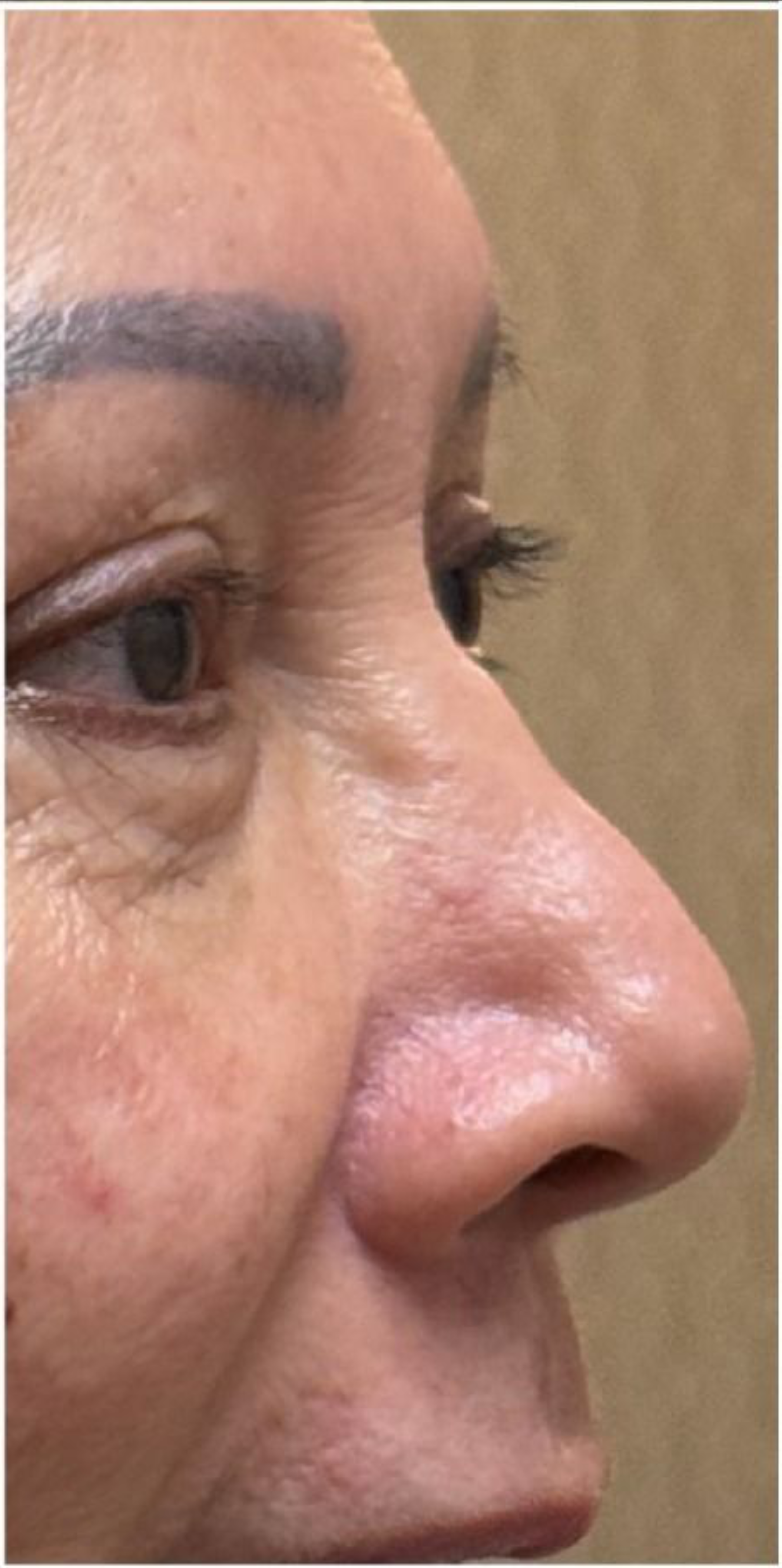 Botox before — Wide Nose, Nasal Tip Drooping, Nasal Flaring, front view