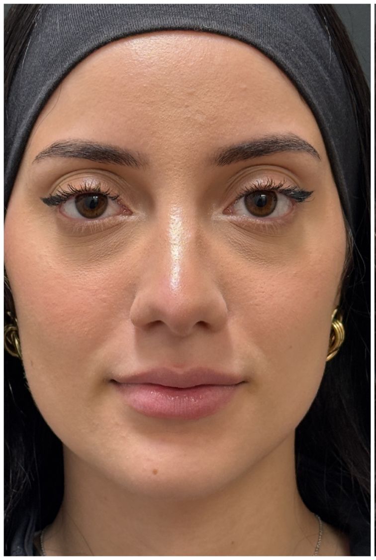 Lip Filler before — Lip Asymmetry, front view