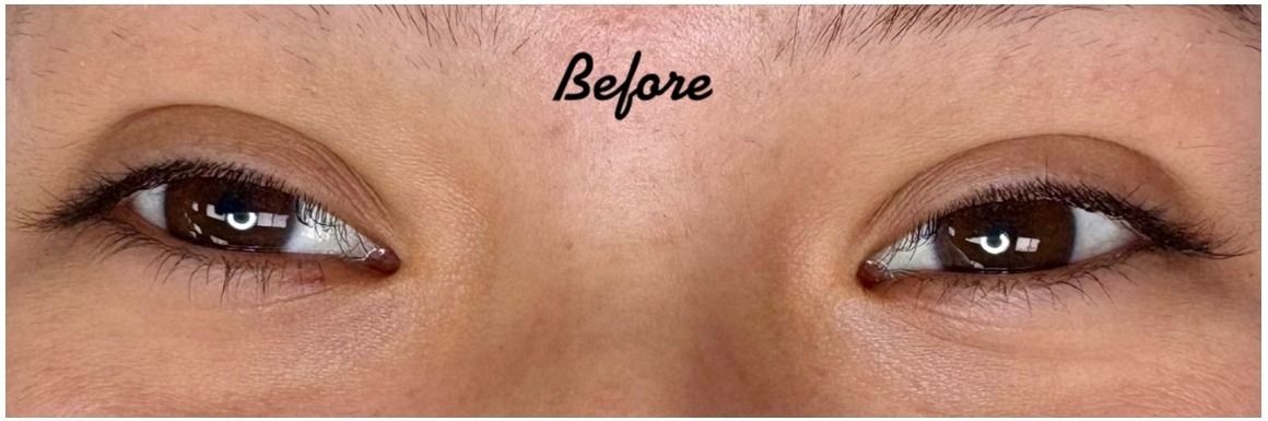 Lash Lift before — Lashes Obscured by Upper Lid, Low Lid Crease, Downward Lash Growth, front view