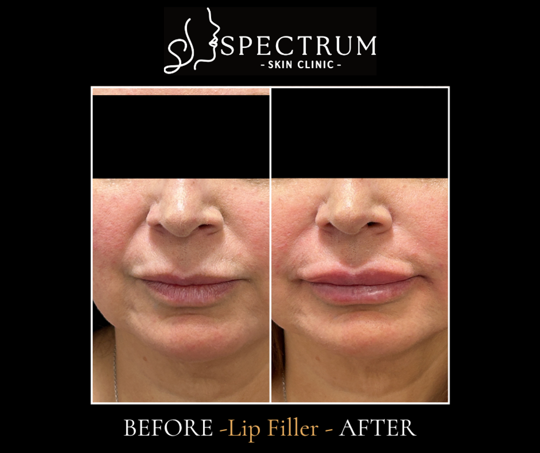 Lip Filler Before and After | Front View Vermilion Definition Irvine CA