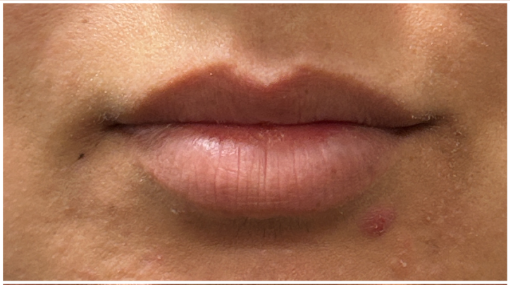 Lip Filler before — Thin Lips, front view