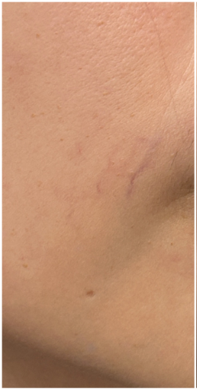 Laser Vein Removal before — Facial Veins, Telangiectasia, Localized Redness, Vascular Lesions, front view